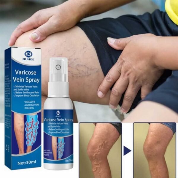 Varicose Veins Treatment Spray!